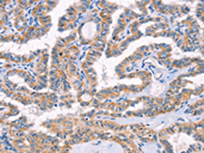 The image on the left is immunohistochemistry of paraffin-embedded Human thyroid cancer tissue using CSB-PA062845(AP1B1 Antibody) at dilution 1/70, on the right is treated with synthetic peptide. (Original magnification: ×200)