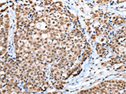 The image on the left is immunohistochemistry of paraffin-embedded Human breast cancer tissue using CSB-PA062933(WDR5 Antibody) at dilution 1/30, on the right is treated with fusion protein. (Original magnification: ×200)