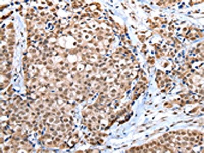 The image on the left is immunohistochemistry of paraffin-embedded Human breast cancer tissue using CSB-PA062933(WDR5 Antibody) at dilution 1/30, on the right is treated with fusion protein. (Original magnification: ×200)