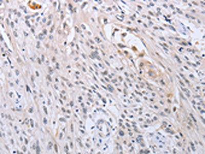 The image on the left is immunohistochemistry of paraffin-embedded Human esophagus cancer tissue using CSB-PA063009(SFRP1 Antibody) at dilution 1/15, on the right is treated with synthetic peptide. (Original magnification: ×200)