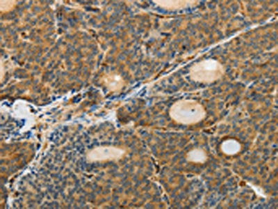 The image on the left is immunohistochemistry of paraffin-embedded Human thyroid cancer tissue using CSB-PA063025(MSN Antibody) at dilution 1/30, on the right is treated with fusion protein. (Original magnification: ×200)