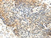 The image on the left is immunohistochemistry of paraffin-embedded Human esophagus cancer tissue using CSB-PA063357(MET Antibody) at dilution 1/30, on the right is treated with synthetic peptide. (Original magnification: ×200)