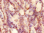 Immunohistochemistry of paraffin-embedded human colon cancer using CSB-PA06339A0Rb at dilution of 1:100