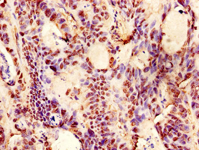 Immunohistochemistry of paraffin-embedded human colon cancer using CSB-PA06339A0Rb at dilution of 1:100