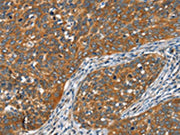The image on the left is immunohistochemistry of paraffin-embedded Human cervical cancer tissue using CSB-PA063513(FZD1 Antibody) at dilution 1/15, on the right is treated with synthetic peptide. (Original magnification: ×200)