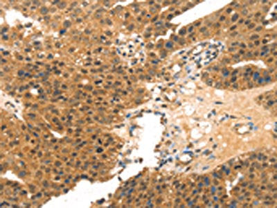 The image on the left is immunohistochemistry of paraffin-embedded Human breast cancer tissue using CSB-PA063617(MED14 Antibody) at dilution 1/20, on the right is treated with synthetic peptide. (Original magnification: ×200)