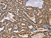 The image on the left is immunohistochemistry of paraffin-embedded Human thyroid cancer tissue using CSB-PA063633(EPHB6 Antibody) at dilution 1/50, on the right is treated with fusion protein. (Original magnification: ×200)