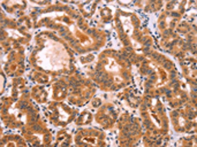 The image on the left is immunohistochemistry of paraffin-embedded Human thyroid cancer tissue using CSB-PA063661(NCEH1 Antibody) at dilution 1/80, on the right is treated with fusion protein. (Original magnification: ×200)
