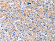 The image on the left is immunohistochemistry of paraffin-embedded Human liver cancer tissue using CSB-PA063689(GAS1 Antibody) at dilution 1/20, on the right is treated with synthetic peptide. (Original magnification: ×200)