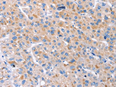 The image on the left is immunohistochemistry of paraffin-embedded Human liver cancer tissue using CSB-PA063689(GAS1 Antibody) at dilution 1/20, on the right is treated with synthetic peptide. (Original magnification: ×200)