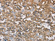 The image on the left is immunohistochemistry of paraffin-embedded Human thyroid cancer tissue using CSB-PA063818(CST2 Antibody) at dilution 1/50, on the right is treated with fusion protein. (Original magnification: ×200)