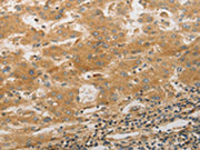 The image on the left is immunohistochemistry of paraffin-embedded Human liver cancer tissue using CSB-PA063825(PPAP2A Antibody) at dilution 1/50, on the right is treated with synthetic peptide. (Original magnification: ×200)