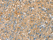 The image on the left is immunohistochemistry of paraffin-embedded Human liver cancer tissue using CSB-PA063984(PTPRN Antibody) at dilution 1/30, on the right is treated with fusion protein. (Original magnification: ×200)