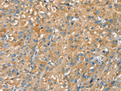 The image on the left is immunohistochemistry of paraffin-embedded Human liver cancer tissue using CSB-PA063984(PTPRN Antibody) at dilution 1/30, on the right is treated with fusion protein. (Original magnification: ×200)