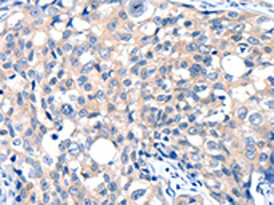 The image on the left is immunohistochemistry of paraffin-embedded Human breast cancer tissue using CSB-PA064073(GRIN2D Antibody) at dilution 1/30, on the right is treated with synthetic peptide. (Original magnification: ×200)