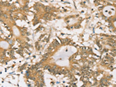 The image on the left is immunohistochemistry of paraffin-embedded Human colon cancer tissue using CSB-PA064103(SIGLEC15 Antibody) at dilution 1/35, on the right is treated with synthetic peptide. (Original magnification: ×200)