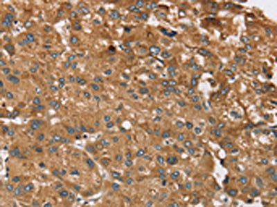 The image on the left is immunohistochemistry of paraffin-embedded Human liver cancer tissue using CSB-PA064210(RPS6KA2 Antibody) at dilution 1/40, on the right is treated with synthetic peptide. (Original magnification: ×200)