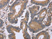 The image on the left is immunohistochemistry of paraffin-embedded Human colon cancer tissue using CSB-PA064264(KIAA1324 Antibody) at dilution 1/30, on the right is treated with fusion protein. (Original magnification: ×200)
