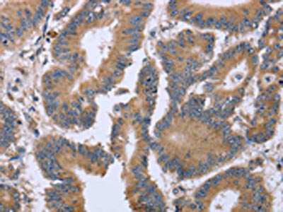 The image on the left is immunohistochemistry of paraffin-embedded Human colon cancer tissue using CSB-PA064264(KIAA1324 Antibody) at dilution 1/30, on the right is treated with fusion protein. (Original magnification: ×200)