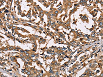 The image on the left is immunohistochemistry of paraffin-embedded Human liver cancer tissue using CSB-PA064313(HSD17B12 Antibody) at dilution 1/40, on the right is treated with fusion protein. (Original magnification: ×200)
