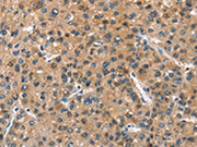 The image on the left is immunohistochemistry of paraffin-embedded Human liver cancer tissue using CSB-PA064362(ASB2 Antibody) at dilution 1/40, on the right is treated with fusion protein. (Original magnification: ×200)