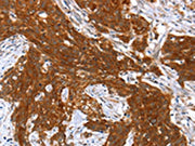 The image on the left is immunohistochemistry of paraffin-embedded Human cervical cancer tissue using CSB-PA064404(HOXB1 Antibody) at dilution 1/40, on the right is treated with fusion protein. (Original magnification: ×200)