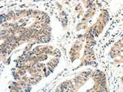 The image on the left is immunohistochemistry of paraffin-embedded Human colon cancer tissue using CSB-PA064607(FAM3A Antibody) at dilution 1/30, on the right is treated with fusion protein. (Original magnification: ×200)