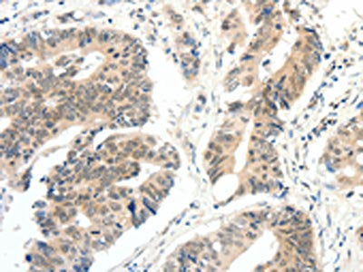 The image on the left is immunohistochemistry of paraffin-embedded Human colon cancer tissue using CSB-PA064607(FAM3A Antibody) at dilution 1/30, on the right is treated with fusion protein. (Original magnification: ×200)