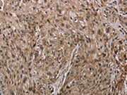 The image on the left is immunohistochemistry of paraffin-embedded Human esophagus cancer tissue using CSB-PA064639(MFF Antibody) at dilution 1/20, on the right is treated with synthetic peptide. (Original magnification: ×200)