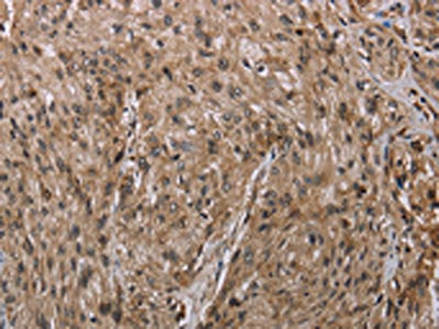 The image on the left is immunohistochemistry of paraffin-embedded Human esophagus cancer tissue using CSB-PA064639(MFF Antibody) at dilution 1/20, on the right is treated with synthetic peptide. (Original magnification: ×200)