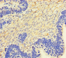 Immunohistochemistry of paraffin-embedded human ovarian cancer using CSB-PA06475A0Rb at dilution of 1:100