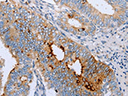 The image on the left is immunohistochemistry of paraffin-embedded Human cervical cancer tissue using CSB-PA064902(ENPP6 Antibody) at dilution 1/15, on the right is treated with fusion protein. (Original magnification: ×200)