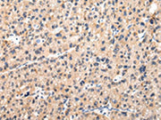 The image on the left is immunohistochemistry of paraffin-embedded Human liver cancer tissue using CSB-PA064912(MUC1(NT) Antibody) at dilution 1/20, on the right is treated with synthetic peptide. (Original magnification: ×200)