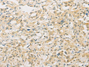 The image on the left is immunohistochemistry of paraffin-embedded Human thyroid cancer tissue using CSB-PA064938(FNTA Antibody) at dilution 1/30, on the right is treated with fusion protein. (Original magnification: ×200)