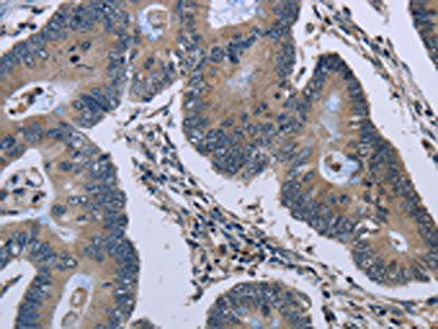 The image on the left is immunohistochemistry of paraffin-embedded Human colon cancer tissue using CSB-PA065045(GJC2 Antibody) at dilution 1/40, on the right is treated with synthetic peptide. (Original magnification: ×200)