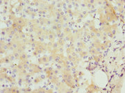 Immunohistochemistry of paraffin-embedded human liver cancer using CSB-PA06515A0Rb at dilution of 1:100