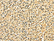 The image on the left is immunohistochemistry of paraffin-embedded Human prostate cancer tissue using CSB-PA065296(DNASE1 Antibody) at dilution 1/25, on the right is treated with fusion protein. (Original magnification: ×200)