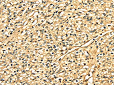 The image on the left is immunohistochemistry of paraffin-embedded Human prostate cancer tissue using CSB-PA065296(DNASE1 Antibody) at dilution 1/25, on the right is treated with fusion protein. (Original magnification: ×200)