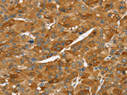 The image on the left is immunohistochemistry of paraffin-embedded Human liver cancer tissue using CSB-PA065340(TNFSF15 Antibody) at dilution 1/40, on the right is treated with synthetic peptide. (Original magnification: ×200)