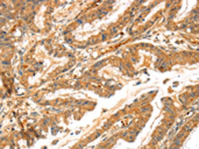 The image on the left is immunohistochemistry of paraffin-embedded Human esophagus cancer tissue using CSB-PA065419(LPP Antibody) at dilution 1/30, on the right is treated with synthetic peptide. (Original magnification: ×200)