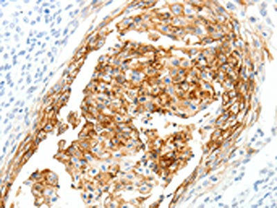 The image on the left is immunohistochemistry of paraffin-embedded Human cervical cancer tissue using CSB-PA065596(SEMA3D Antibody) at dilution 1/40, on the right is treated with synthetic peptide. (Original magnification: ×200)