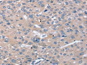 The image on the left is immunohistochemistry of paraffin-embedded Human liver cancer tissue using CSB-PA065668(STK36 Antibody) at dilution 1/20, on the right is treated with synthetic peptide. (Original magnification: ×200)