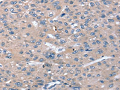 The image on the left is immunohistochemistry of paraffin-embedded Human liver cancer tissue using CSB-PA065668(STK36 Antibody) at dilution 1/20, on the right is treated with synthetic peptide. (Original magnification: ×200)