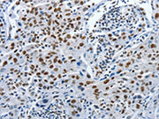 The image on the left is immunohistochemistry of paraffin-embedded Human lung cancer tissue using CSB-PA065706(PIWIL3 Antibody) at dilution 1/20, on the right is treated with synthetic peptide. (Original magnification: ×200)