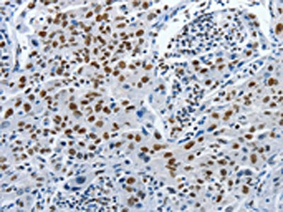 The image on the left is immunohistochemistry of paraffin-embedded Human lung cancer tissue using CSB-PA065706(PIWIL3 Antibody) at dilution 1/20, on the right is treated with synthetic peptide. (Original magnification: ×200)