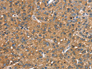 The image on the left is immunohistochemistry of paraffin-embedded Human liver cancer tissue using CSB-PA065723(CR1 Antibody) at dilution 1/25, on the right is treated with synthetic peptide. (Original magnification: ×200)