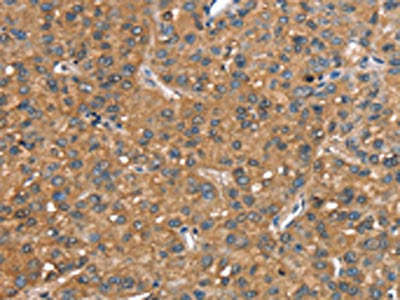 The image on the left is immunohistochemistry of paraffin-embedded Human liver cancer tissue using CSB-PA065723(CR1 Antibody) at dilution 1/25, on the right is treated with synthetic peptide. (Original magnification: ×200)