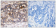 Immunohistochemical analysis of paraffin-embedded human breast carcinoma tissue using Shc1(Ab-427) Antibody(left) or the same antibody preincubated with blocking peptide(right).