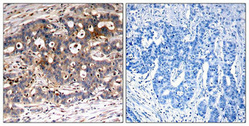 Immunohistochemical analysis of paraffin-embedded human breast carcinoma tissue using Shc1(Ab-427) Antibody(left) or the same antibody preincubated with blocking peptide(right).