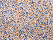 The image on the left is immunohistochemistry of paraffin-embedded Human liver cancer tissue using CSB-PA065885(PLIN2 Antibody) at dilution 1/20, on the right is treated with synthetic peptide. (Original magnification: ×200)